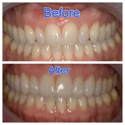 Davis Dentistry - Upper Veneers