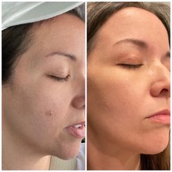 Rewind Skin Spa - Before and after photos