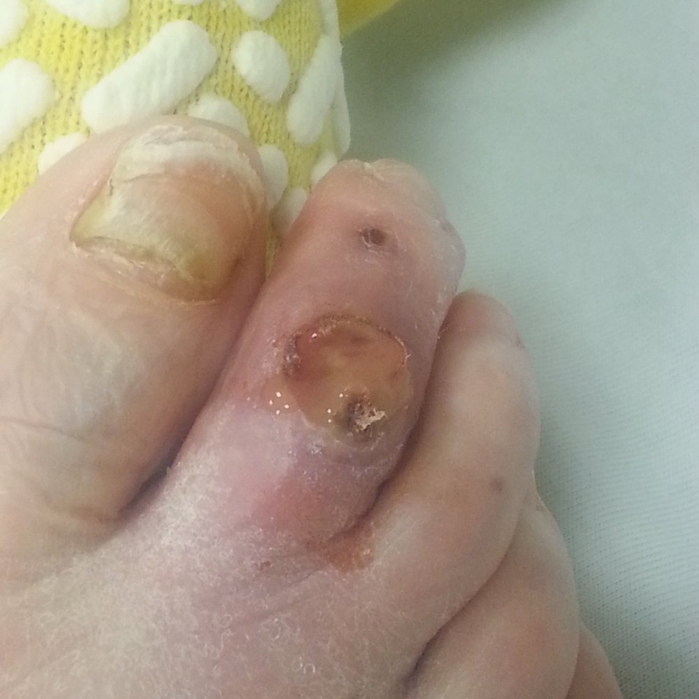 Severe MRSA infection Severe MRSA infection