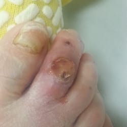 Ministering Physicians - Severe MRSA infection