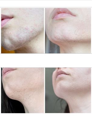 Associates In Electrology & Advanced Laser Therapy