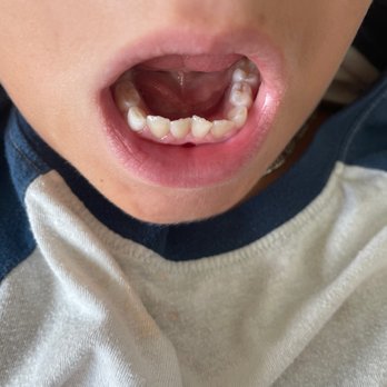 Brock Orthodontics - Katy West - The bottom teeth that had braces on them. - Orthodontists Near Me - Katy, Texas Brock Orthodontics - Katy West - The bottom teeth that had braces on them. - Orthodontists Near Me - Katy, Texas