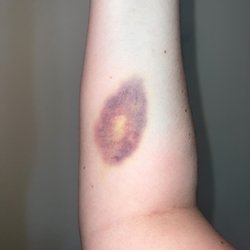 OakBend Medical Center - Williams Way Hospital Campus - Bruise, right arm, with flash