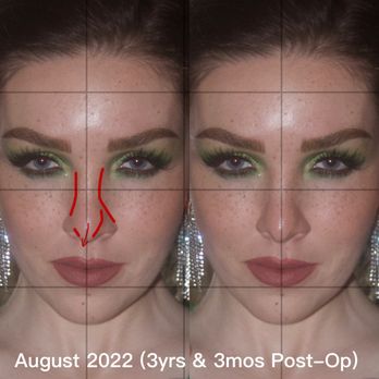Pacific Heights Plastic Surgery - This shows how my columella which was also "corrected," now veers to the right - Cosmetic Surgeons Near Me - San Francisco, California