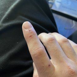 Broken Skin from 3 bites.