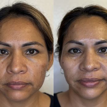 Glow in Grace Aesthetics - This client has had multiple sessions of our signature Hydrafusion facial and Microneedling package - Medical Spas Near Me - Carson, California Glow in Grace Aesthetics - This client has had multiple sessions of our signature Hydrafusion facial and Microneedling package - Medical Spas Near Me - Carson, California