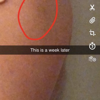 Medical Weight Controls - Still a little bruise after one week it was really noticeable day 2-5 - Medical Spas Near Me - Long Beach, California Medical Weight Controls - Still a little bruise after one week it was really noticeable day 2-5 - Medical Spas Near Me - Long Beach, California