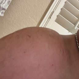 Almost one month, swelling is not visible anymore, I believe this is particularly due to laser therapy. Almost one month, swelling is not visible anymore, I believe this is particularly due to laser therapy.