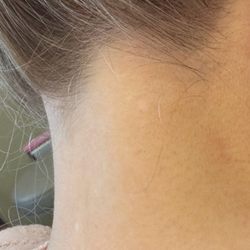 OC MedDerm - After removal