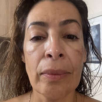 LA Beauty Skin Center - The before and after are the same after more than eight months. - Medical Spas Near Me - Pasadena, California LA Beauty Skin Center - The before and after are the same after more than eight months. - Medical Spas Near Me - Pasadena, California