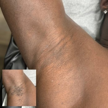 Amos Glow Studio - Before & after: Male underarm wax - Waxing Near Me - Manassas, Virginia Amos Glow Studio - Before & after: Male underarm wax - Waxing Near Me - Manassas, Virginia