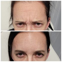 Drew & Co. Medical Aesthetics - Before and after anti-wrinkle injections with botox!