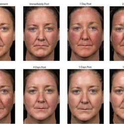 Daniel Behroozan, MD, FAAD, FACMS - Day by day recovery. FDA-approved, Fraxel aims to reduce the appearance of fine lines and wrinkles, skin pigmentation, sun damage and acne.