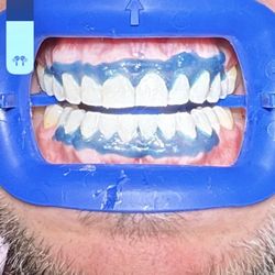 Juanita Family Dentistry - During!  I loved the care used to protect my gums!