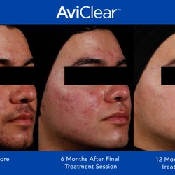 Orchid Medical Clinic - We are now providing an advanced, fast, effective and safe treatment to treat mild to severe acne at orchid medical clinic.