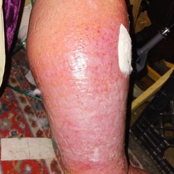 Professional Home Health Care - Recent photo showing remarkable progress because of the treatment I receive from Jasmine.
