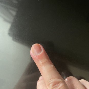 Nail 45 - Infected finger from unsanitary nail tools - Nail Salons Near Me - Los Angeles, California