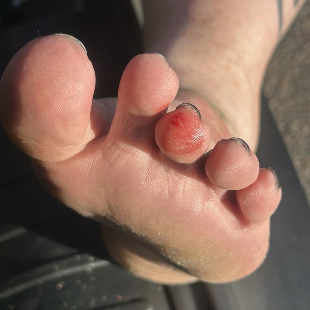 Nails Pro Spa - My toe that was hurt part 2 - Nail Salons Near Me - Edgewater, Colorado Nails Pro Spa - My toe that was hurt part 2 - Nail Salons Near Me - Edgewater, Colorado