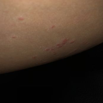 Neroli Institute - Rash around my thighs after 8 treatments of dual waves and z wave. Def not recommend it for everyone. - Laser Hair Removal Near Me - Vienna, Virginia