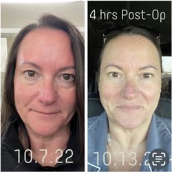 Fred Wilder, M.D - This picture was taken six days prior to explant and the second picture was four hours post-op!