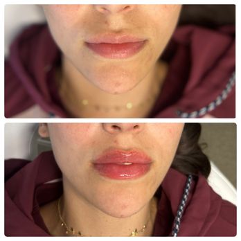 Transformative Wellness - Lip Filler! - IV Hydration Near Me - Vista, California Transformative Wellness - Lip Filler! - IV Hydration Near Me - Vista, California