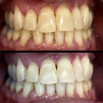 Bambii Lash Lounge - Teeth whitening. On average you can see 4-6 shades of lift in one appointment - Waxing Near Me - Vancouver, Washington Bambii Lash Lounge - Teeth whitening. On average you can see 4-6 shades of lift in one appointment - Waxing Near Me - Vancouver, Washington