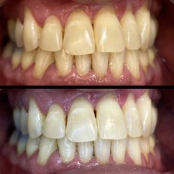 Bambii Lash Lounge - Teeth whitening. On average you can see 4-6 shades of lift in one appointment