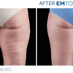 Skin Sanctuary Medspa - EmTone is FDA cleared!