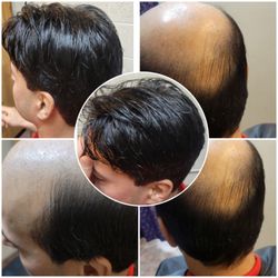 Las Vegas Hair Center - Before and after hair replacement. Happy client