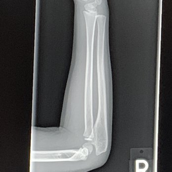 Imaging Partners - My daughters arm. Not meaty.  Just the right amount of meat. - Diagnostic Imaging Near Me - Orange, California