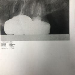 Westwind Dental - Phoenix - X-ray showing broken file tip left behind in root canal