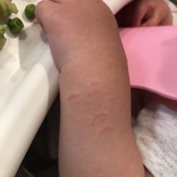 Gardens Pediatrics - Nail marks