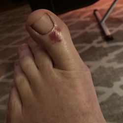 Sky Nails - Big toe torture injury