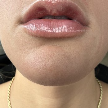 Onassis Skin - The results after just 1 week after getting 1/2 a syringe - Medical Spas Near Me - Beverly Hills, California Onassis Skin - The results after just 1 week after getting 1/2 a syringe - Medical Spas Near Me - Beverly Hills, California