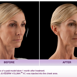 Daniel Behroozan, MD, FAAD, FACMS - A favorite in our office! Voluma XC