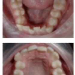 Sky Ortho - Before braces.