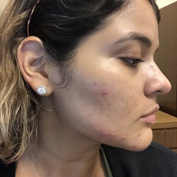 Rachel Harper Skincare - Before - Skin Care Near Me - Houston, Texas