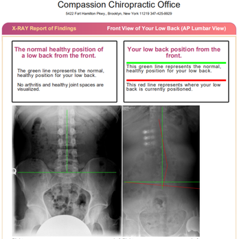 Compassion Chiropractic Office - Lumbar x-ray - Chiropractors Near Me - Brooklyn, New York Compassion Chiropractic Office - Lumbar x-ray - Chiropractors Near Me - Brooklyn, New York