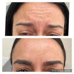 4Ever Young Anti Aging Solutions - Before and after Botox