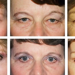 Theodore Staahl, MD - Center For Cosmetic Surgery - Eyelid Surgery/Blepharoplasty removes puffiness and bags under the eyes that make you look worn and tired.