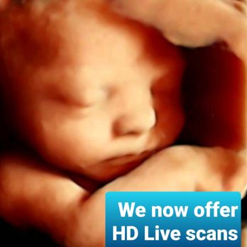 Blessings 3D 4D Ultrasound - You can now add HD Live service to any ultrasound package. - Diagnostic Imaging Near Me - Palmdale, California Blessings 3D 4D Ultrasound - You can now add HD Live service to any ultrasound package. - Diagnostic Imaging Near Me - Palmdale, California