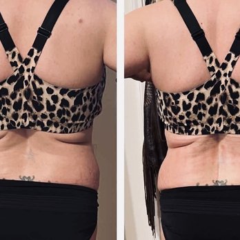 Snatched BodyWorks - Body Contouring Near Me - Burleson, Texas Snatched BodyWorks - Body Contouring Near Me - Burleson, Texas