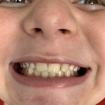 Inessa Kandov, DDS - Bayview Orthodontics - 5 months later - Orthodontists Near Me - Bayside, New York Inessa Kandov, DDS - Bayview Orthodontics - 5 months later - Orthodontists Near Me - Bayside, New York