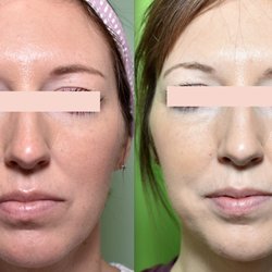 New Body Aesthetics - IPL (Intense Pulse Light) also known as a Photofacial