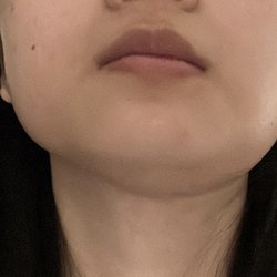 Nevada OMS - Dr. Michel Daccache DDS & Dr. Spencer Armuth DMD MD - This is how my under jaw look now lol