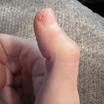 Future Nails - Current state of thumb from infection - Nail Salons Near Me - North Riverside, Illinois