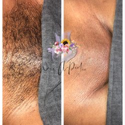 Waxx A Peel - Before and After Brazilian Waxx!