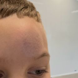 Hit with baseball
