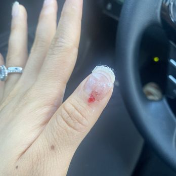 Glamour Nails - This is less bleeding on my left thumb I was bleeding way more inside before he put acetone - Nail Salons Near Me - Fitchburg, Wisconsin Glamour Nails - This is less bleeding on my left thumb I was bleeding way more inside before he put acetone - Nail Salons Near Me - Fitchburg, Wisconsin