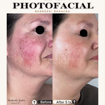 Allure Skin and Laser - Lumenis IPL or Photofacial for redness and broken capillaries. - Skin Care Near Me - Queen Creek, Arizona Allure Skin and Laser - Lumenis IPL or Photofacial for redness and broken capillaries. - Skin Care Near Me - Queen Creek, Arizona